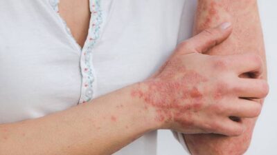 Tips Praktis Mengatasi Peradangan di Tubuh Secara Alami