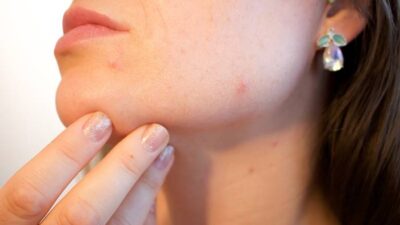 IDI Atambua NTT Ungkap Kemungkinan Dampak Buruk Kosmetik Ilegal Anti Jerawat bagi Kulit Remaja